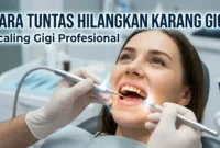 Ilustrasi Pembersihan Karang Gigi.