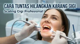 Ilustrasi Pembersihan Karang Gigi.